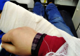 Сломанная рука журналиста Сергея Колотовкина